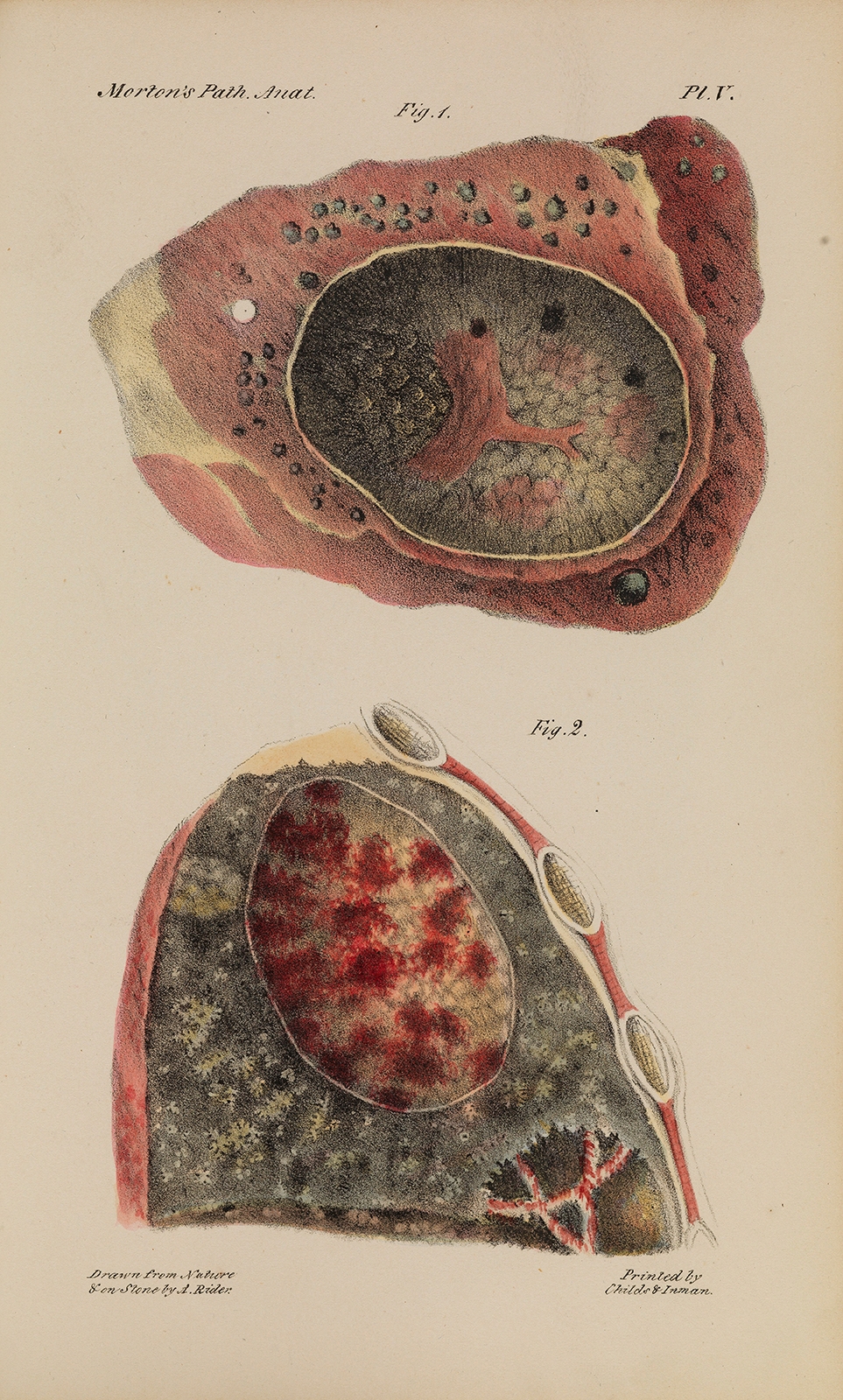 Colour illustration showing diseased lungs in close up. 