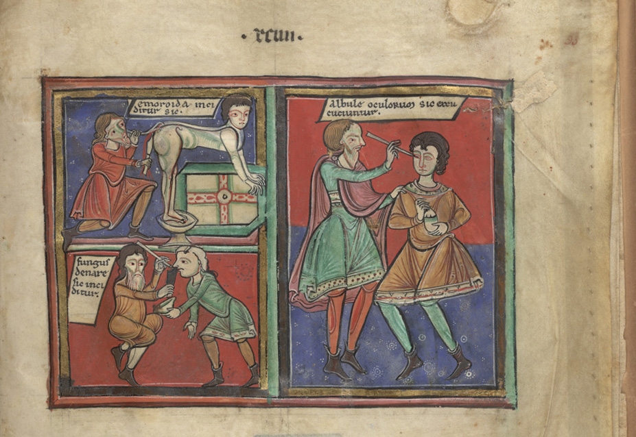 An extract from an illuminated manuscript showing three panels with medical procedures: a man bending over having an haemarroid removed from his anus by a physician; a physican removing a nasal growth with a long straight instrument and a physician removing a cataract from a man's eye with a long straight tool. 