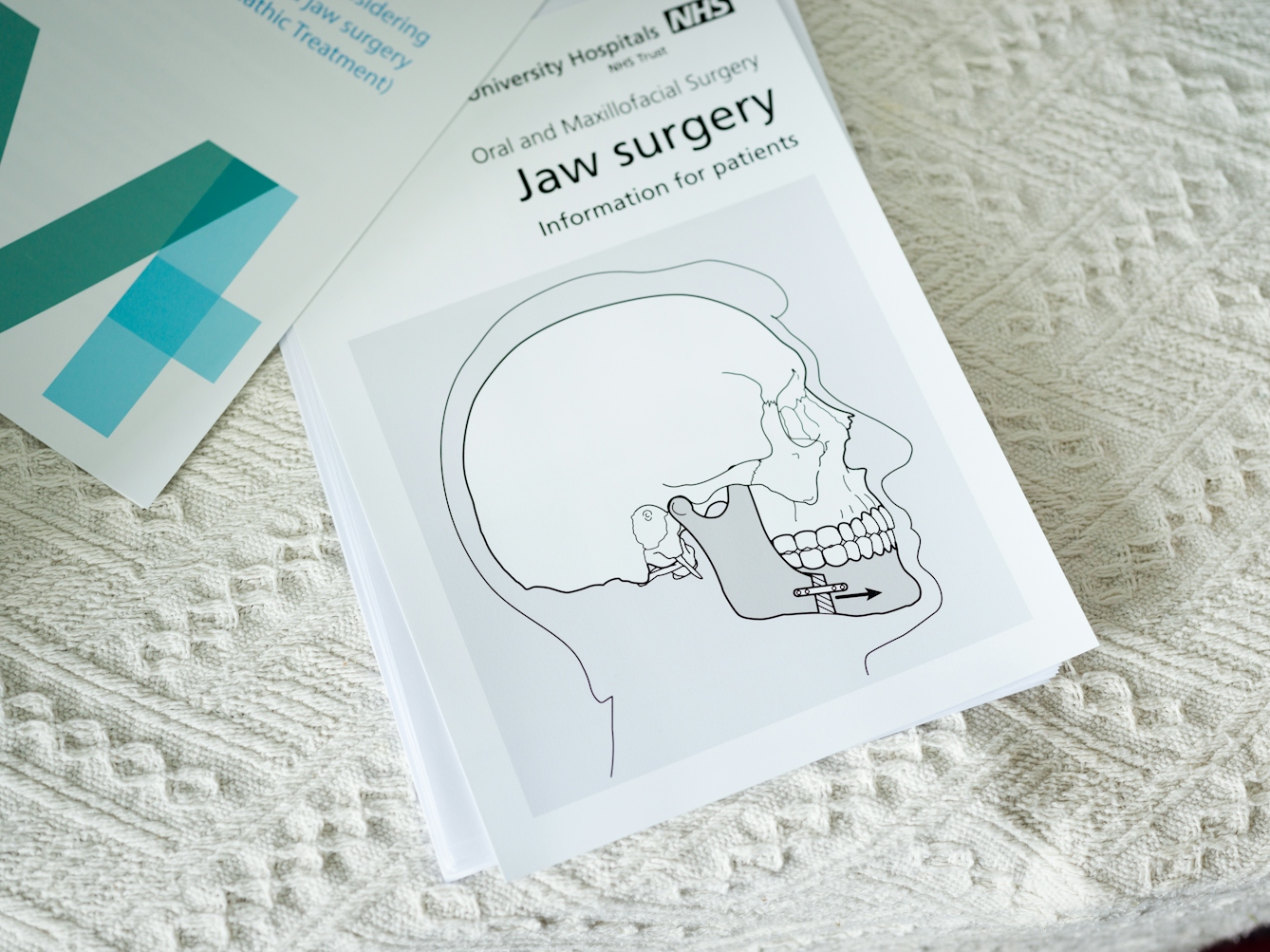 Photograph of a table top covered in a white textured fabric tablecloth. On top of the fabric are several sheets of printed A4 paper. The sheet in the centre of the image is titled, 'Jaw surgery, Information for patients'. Under the title is a diagram of a human head in profile and cross section, revealing the skull. The jaw line has graphical representations of the surgical procedure in the form of bracing and an arrow.
