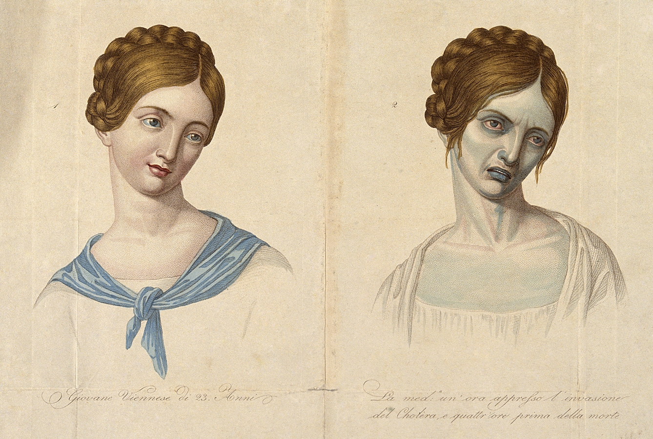 V0010485 A young Viennese woman, aged 23, depicted before and after