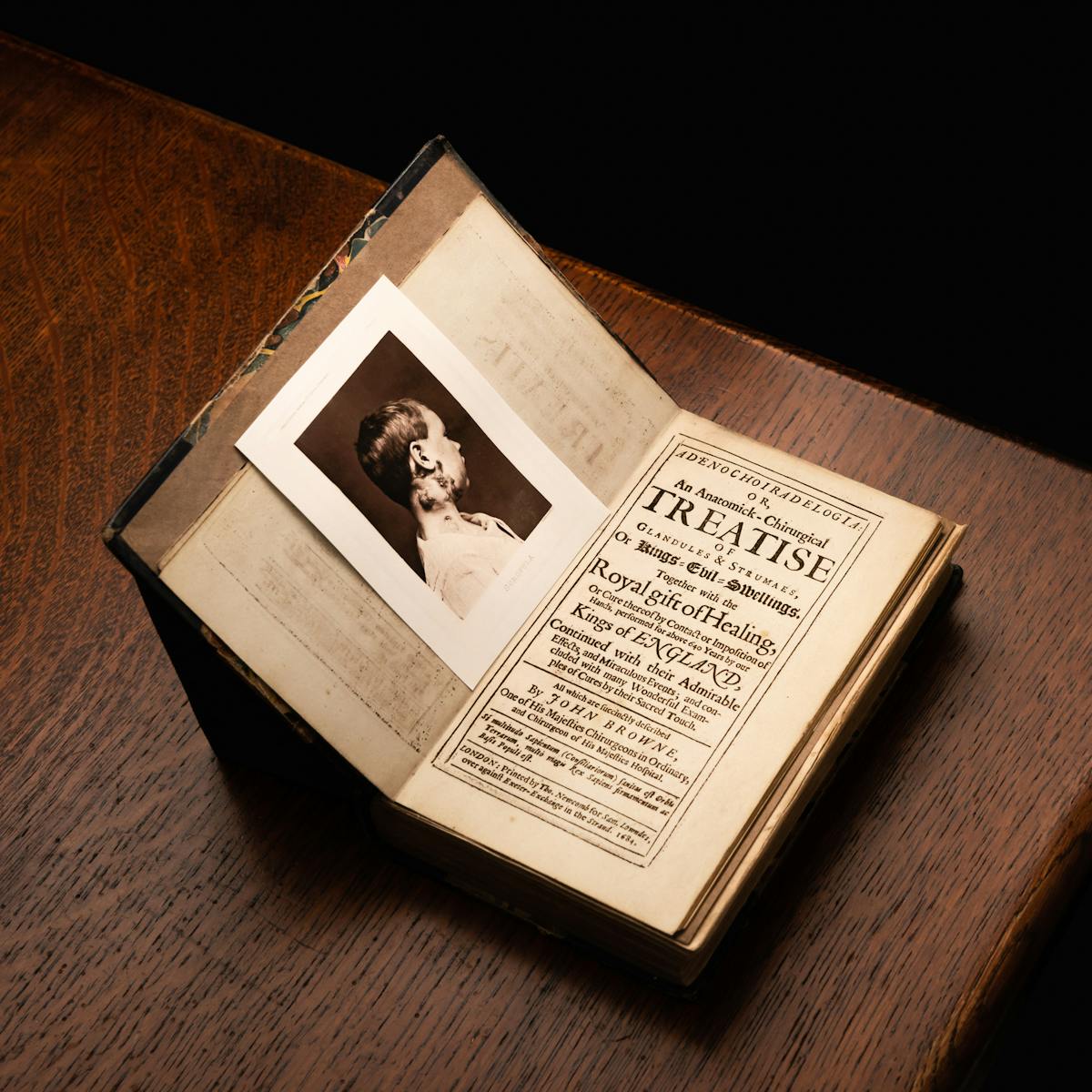 A photograph of a printed book positioned on the corner of a dark wooden table. The book is open at the title page, which reads in part Treatise of Glandules and Strumaes or Kings Evil Swellings. Positioned on the opposite page is photograph of a young boy viewed in profile, running up his neck to below his right ear are darkened swellings.