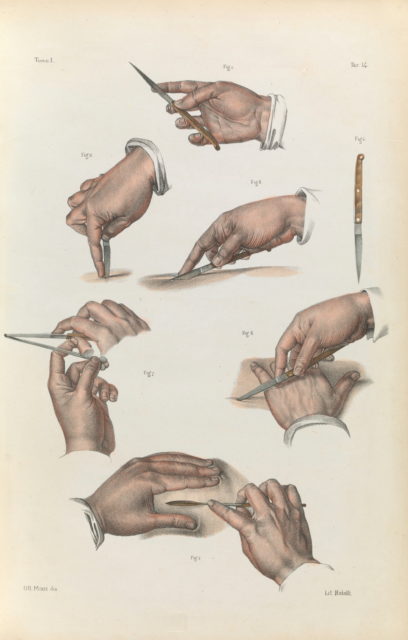 Drawing of hands holding scalpels in different positions.