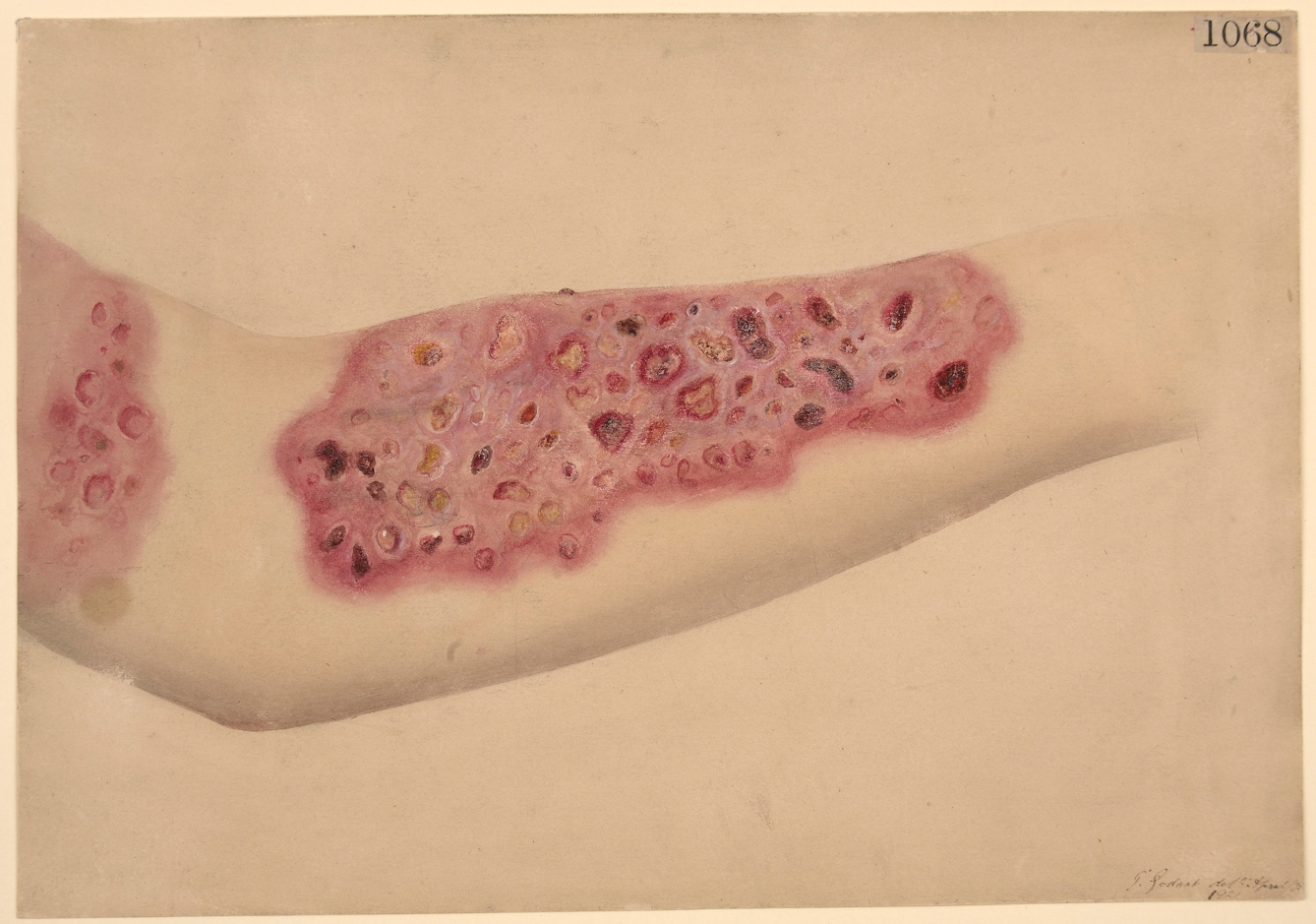 Watercolour drawing showing ulceration of the forearm with lots of red sores.