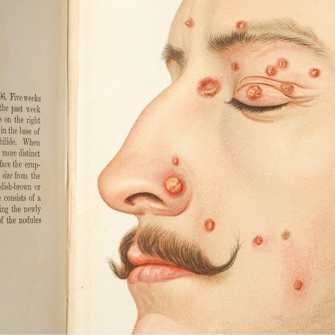 Photograph of an illustration in a book showing a man's face with evidence of syphilis, in the form of red pustules.