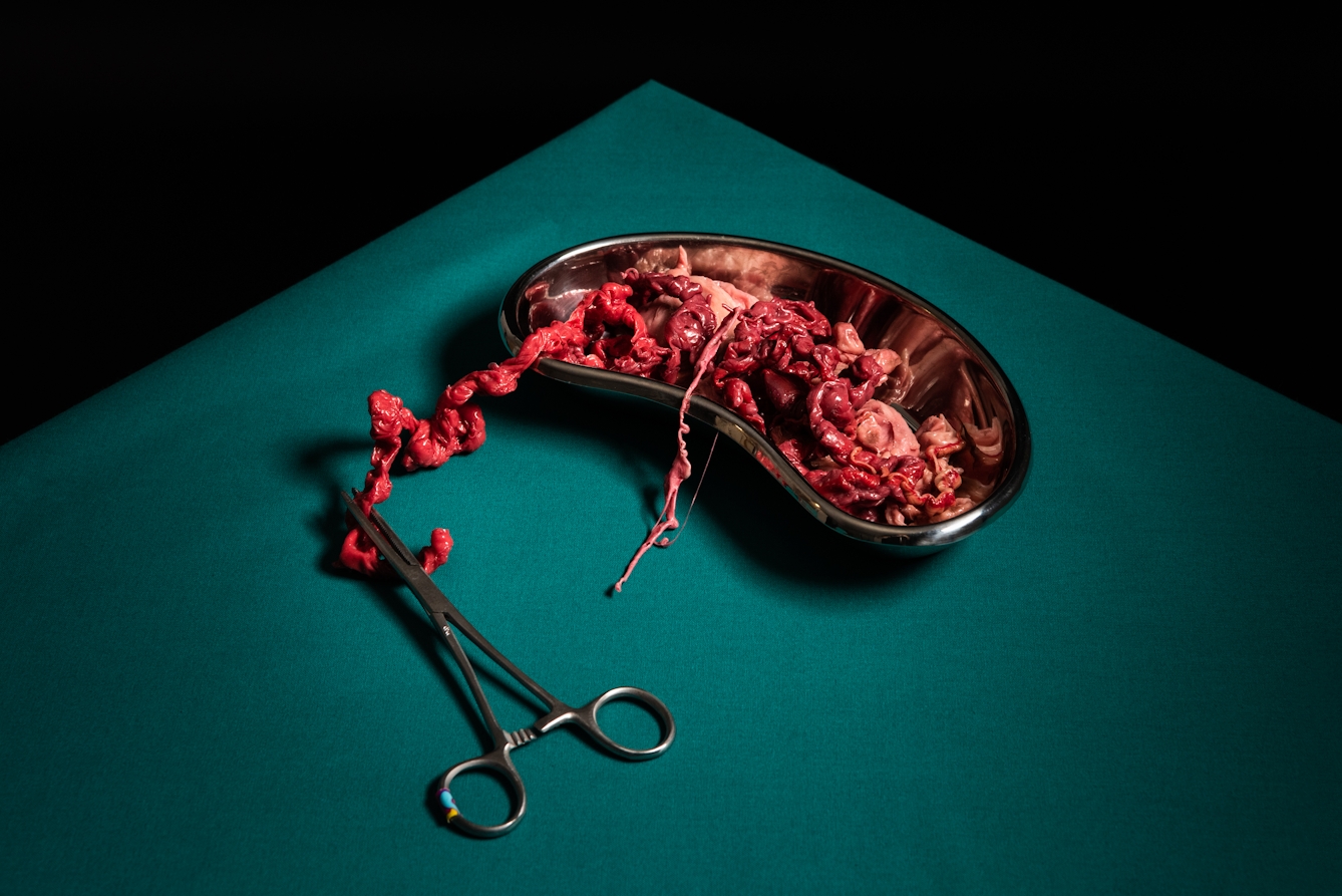 Photograph of the corner of a table covered in a green surgical sheet. On the sheet is a chrome surgical kidney dish. Inside the dish is what looks like a collection of internal human body tissue, fat, sinew and entrails, made up of reds, pinks and browns. A section of this matter extends out of the dish and is clamped in a pair of surgical chrome forceps. The background behind the table edge is black.  