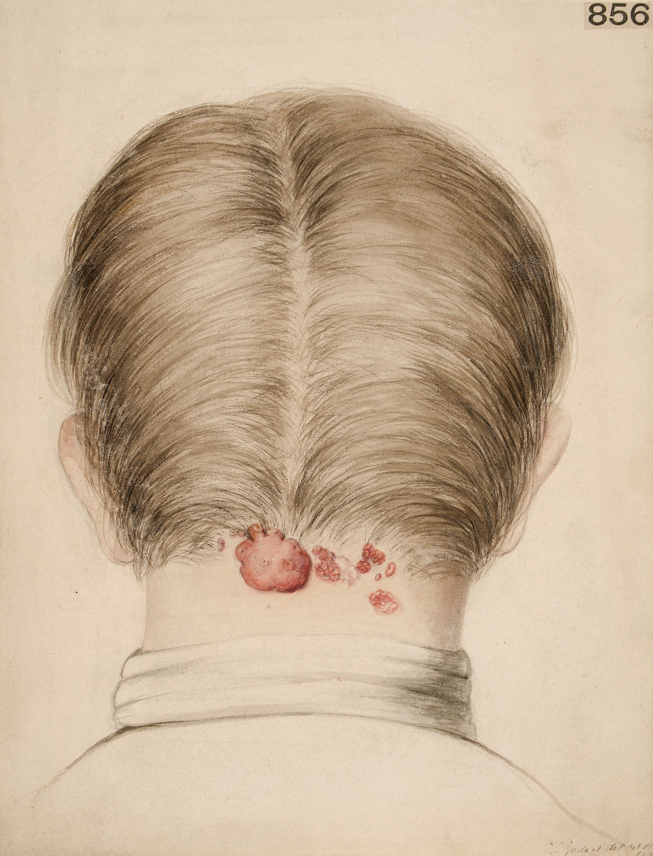 Photograph of an illustration show the back of a man's head, neck and shoulders. On his neck is a red acne keloid.