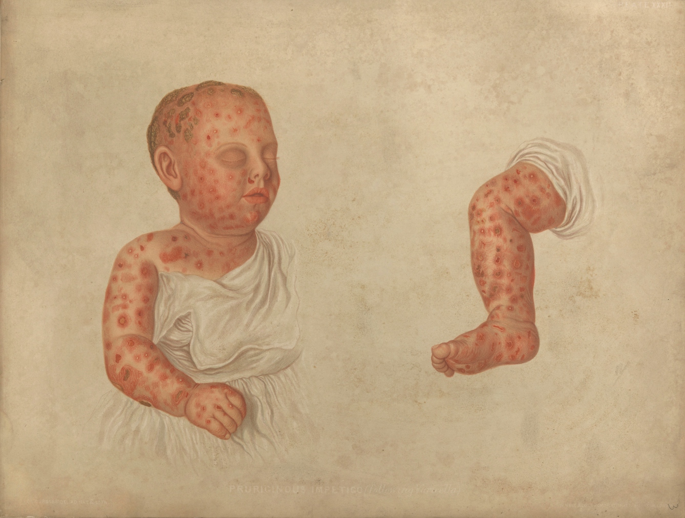 Watercolour of a baby with a skin condition. Red bumps are spread across the face and body.