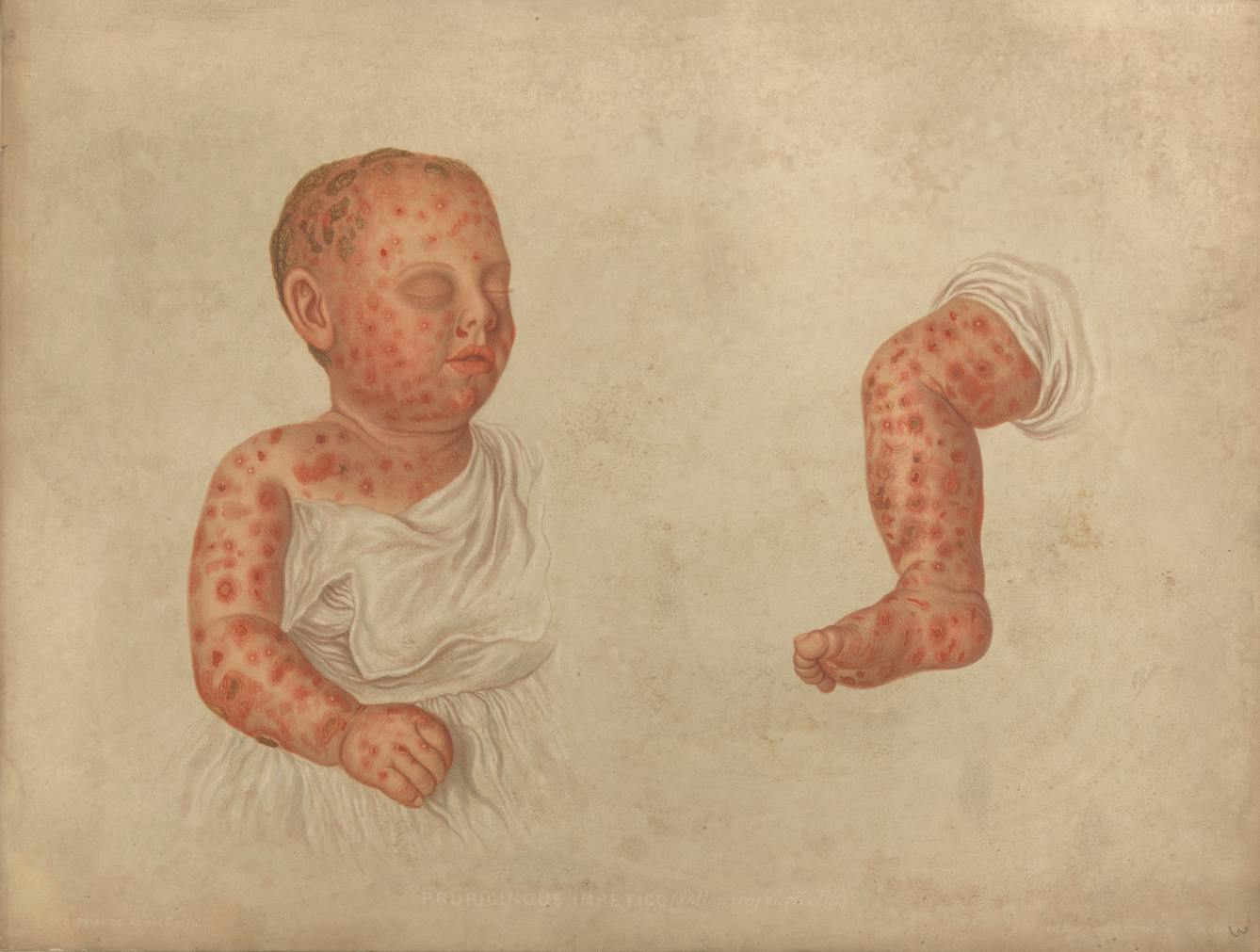 Watercolour of a baby with a skin condition. Red bumps are spread across the face and body. 
