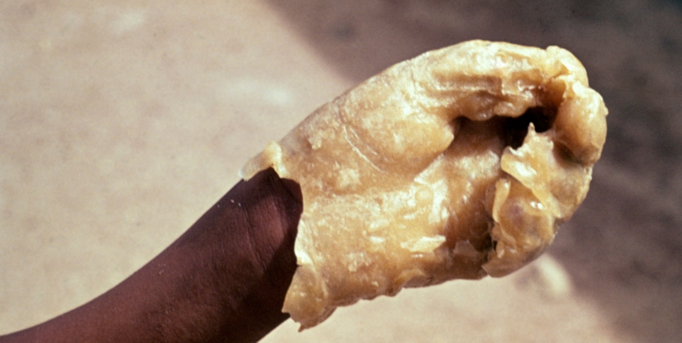 Colour photograph of a human, black skinned hand and wrist against a plain beige background. The hand is clawed and covered in yellow wax up to the wrist as a form of wax therapy.