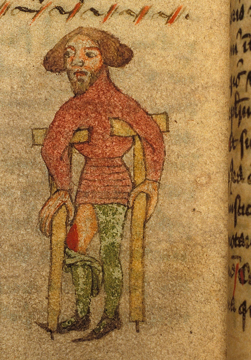 A painted illustration from a manuscript of a man using a pair of crutches with supports under his armpits and what appear to be spikes at the base of each crutch. One of the man's green stockings has fallen to below his knee exposing a red wound. on his thigh.