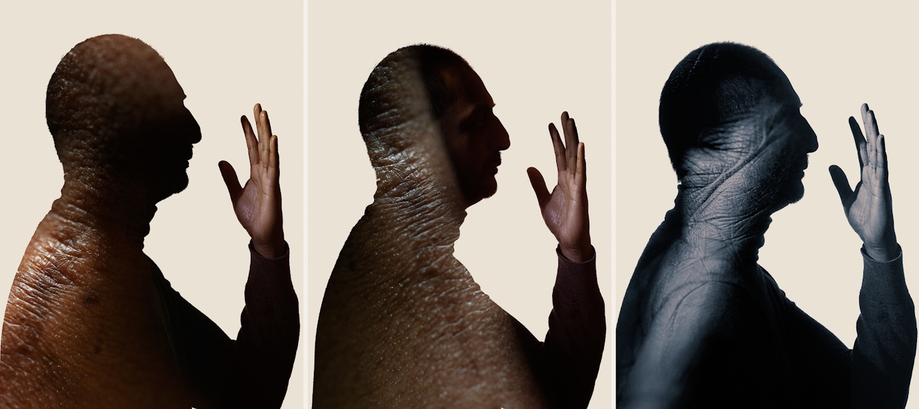 Photographic triptych. Each image shows a portrait of a man's head and shoulders in profile, looking to the right. He is pictured in silhouette against a cream background. Overlaid onto each silhouette is an image of a different scar, showing the texture of the skin and the scar tissue. The images of the scar become more monotone from each image, left to right.