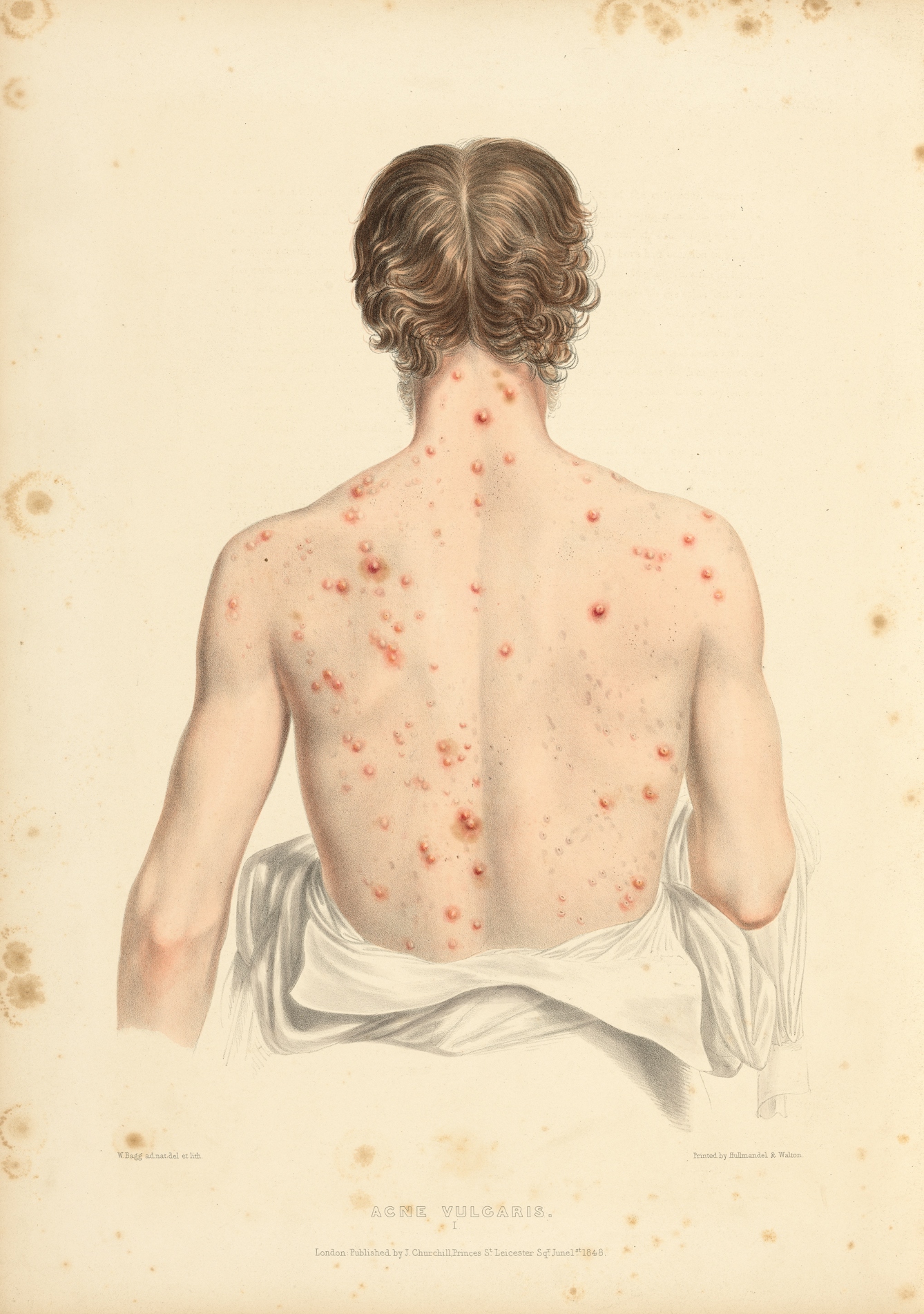 Photograph of an illustration showing the back of a man's head, neck and back. On his neck and back are acne keloids. 