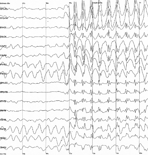 Several lines of graphical wavy lines growing increasingly erratic