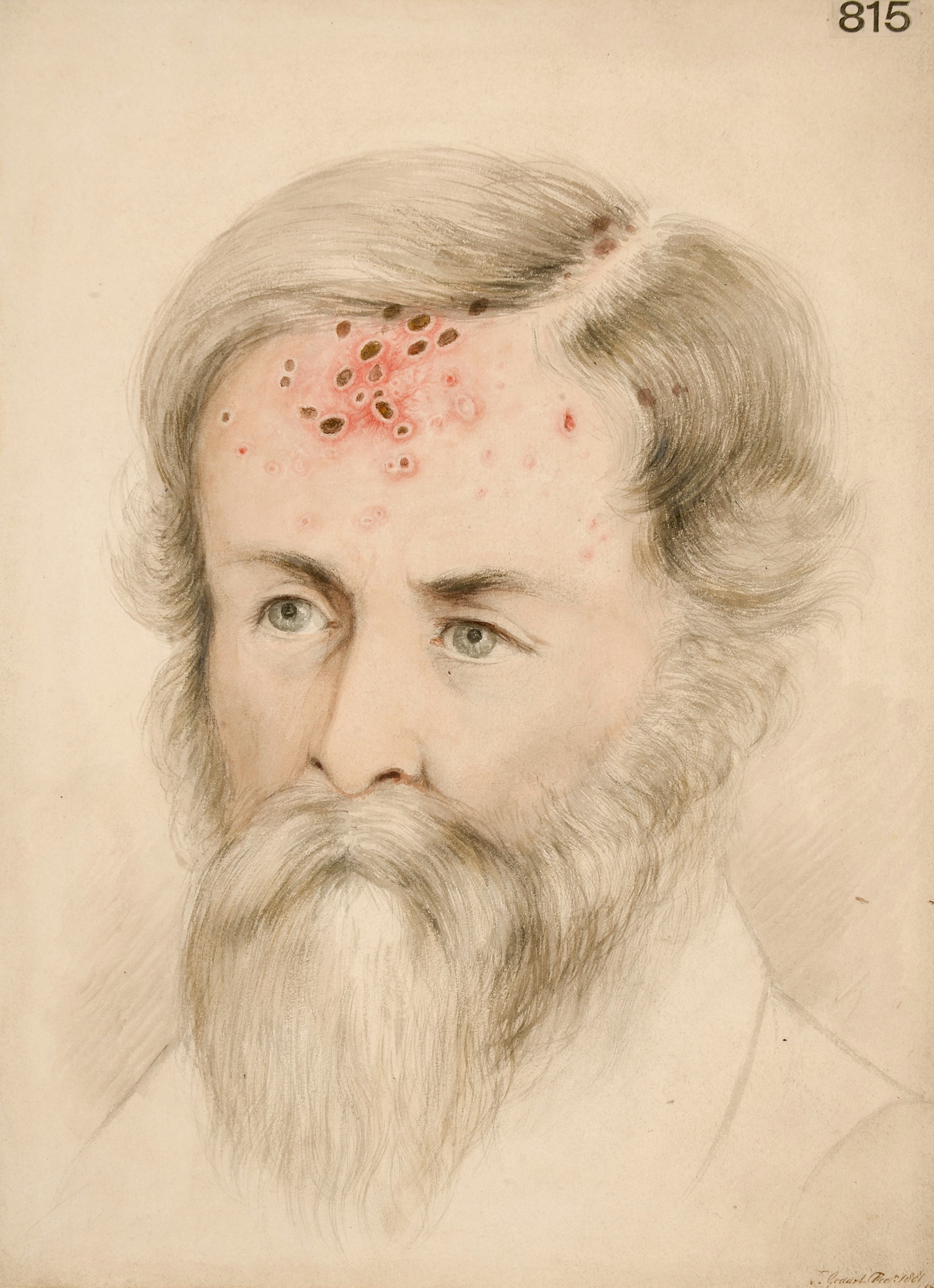 Photograph of an illustration showing the head and shoulders of a man, with red acne marks on his face.