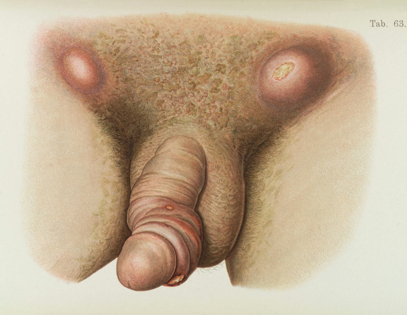 Illustration of male pubis and penis diseased with Syphilis