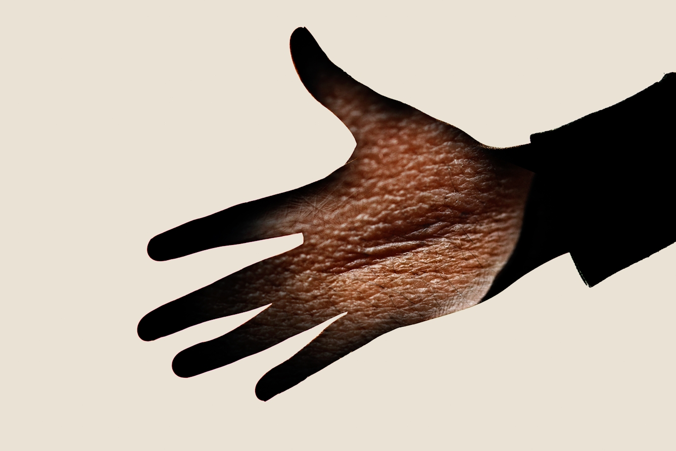 Photographic portrait of a man's outstretched hand. It is pictured in silhouette against a cream background, showing the cuff of his jumper. Overlaid onto the palm of his hand is an image of a scar, showing the texture of the skin and the scar tissue. 