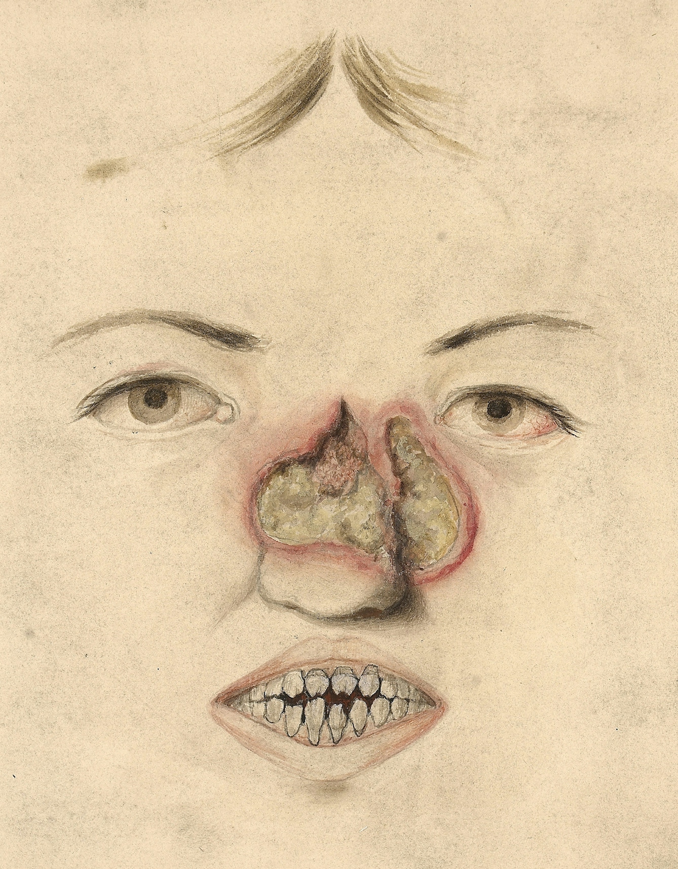 A 15-year-old girl with congenital syphilis.