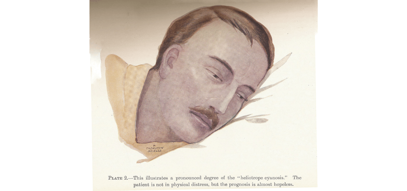 Drawing of a man with cyanosis. Text reads: Plate 2. This illustrates a pronounced degree of the "heliotrope cyanosis." The patient is not in physical distress, but the prognosis is almost hopeless.
