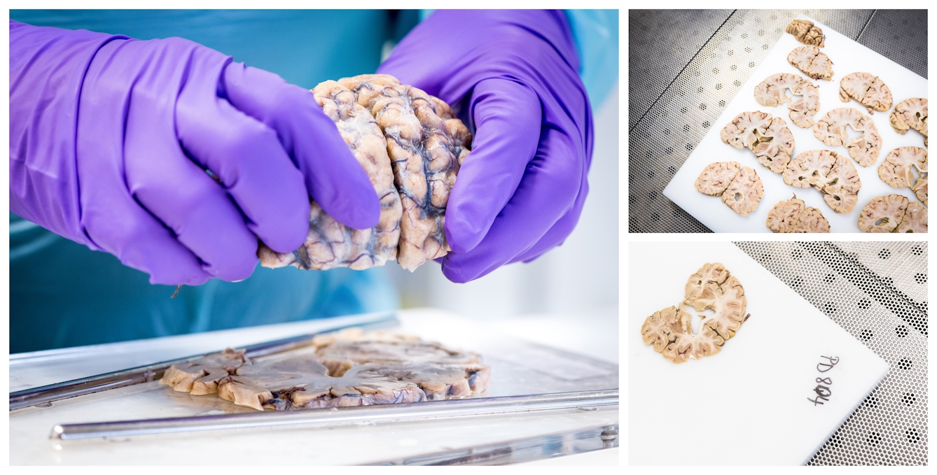 Three photographs clustered together, one large, two small. The large image shows the Neuropathologist in the process of cutting a slice through the brain on the slicing board. The two smaller images show the slices of brain laid out on the larger chopping board.