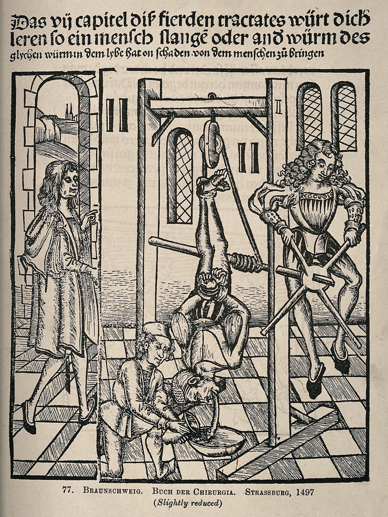 15th-century woodcut showing a man supervising two assistants, one of which is pouring liquid onto the worm emitting from the patient's mouth (the patient is hanging upside-down from a contraption), the other is turning the rope of the apparatus to tighten the grip on the patient