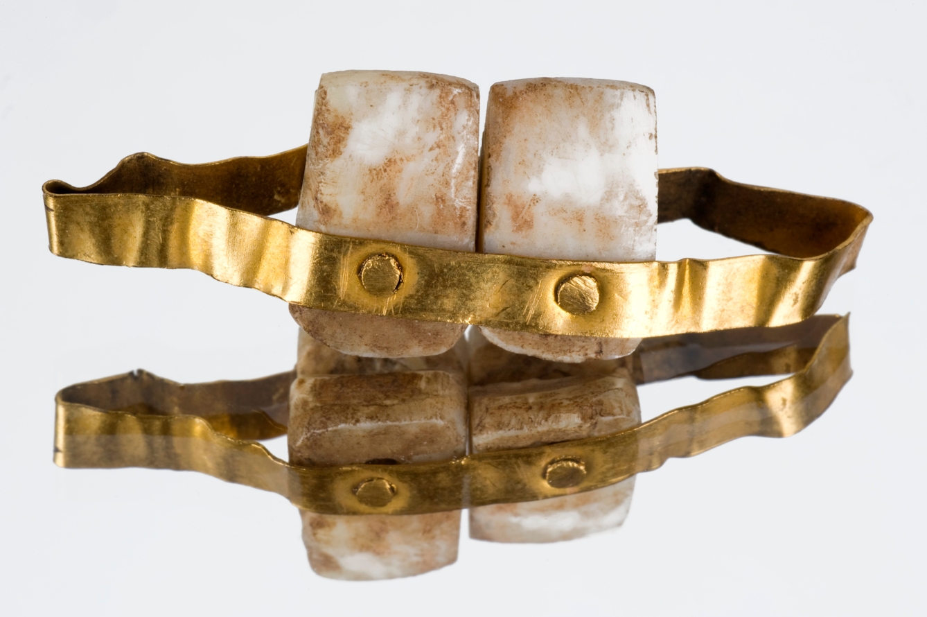 Two simple rectangular false teeth surrounded by a metal band, with nails holding the teeth in place.