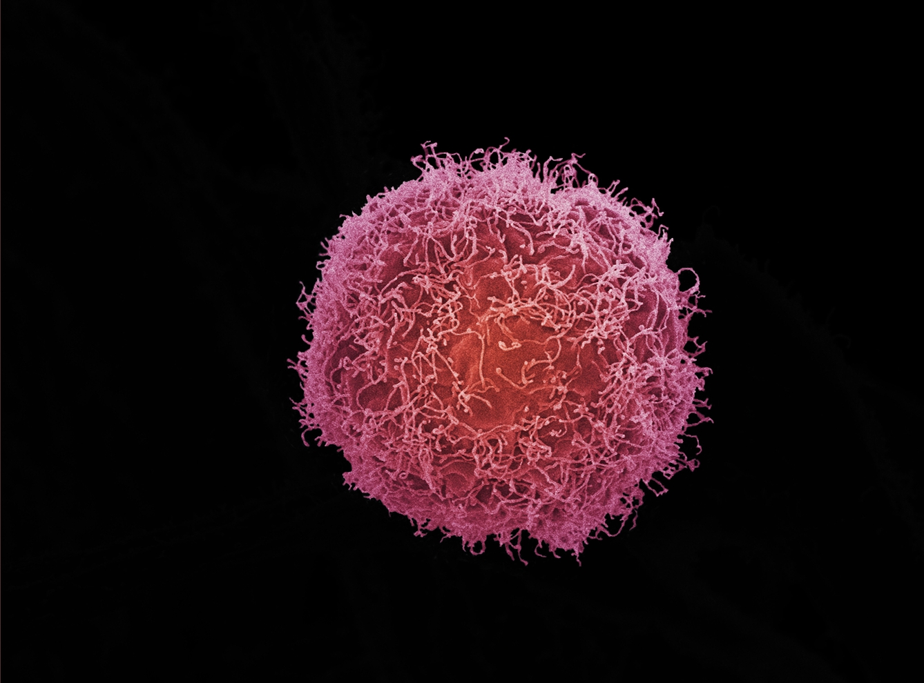 Colour photograph featuring an enlarged image of a skin cancer cell against a black background. The cell is spherical, pink and orange, and covered in string-like pink and orange strands.