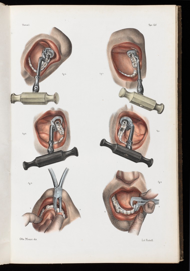 Colour illustrations of tooth being pulled out using a variety of tools.