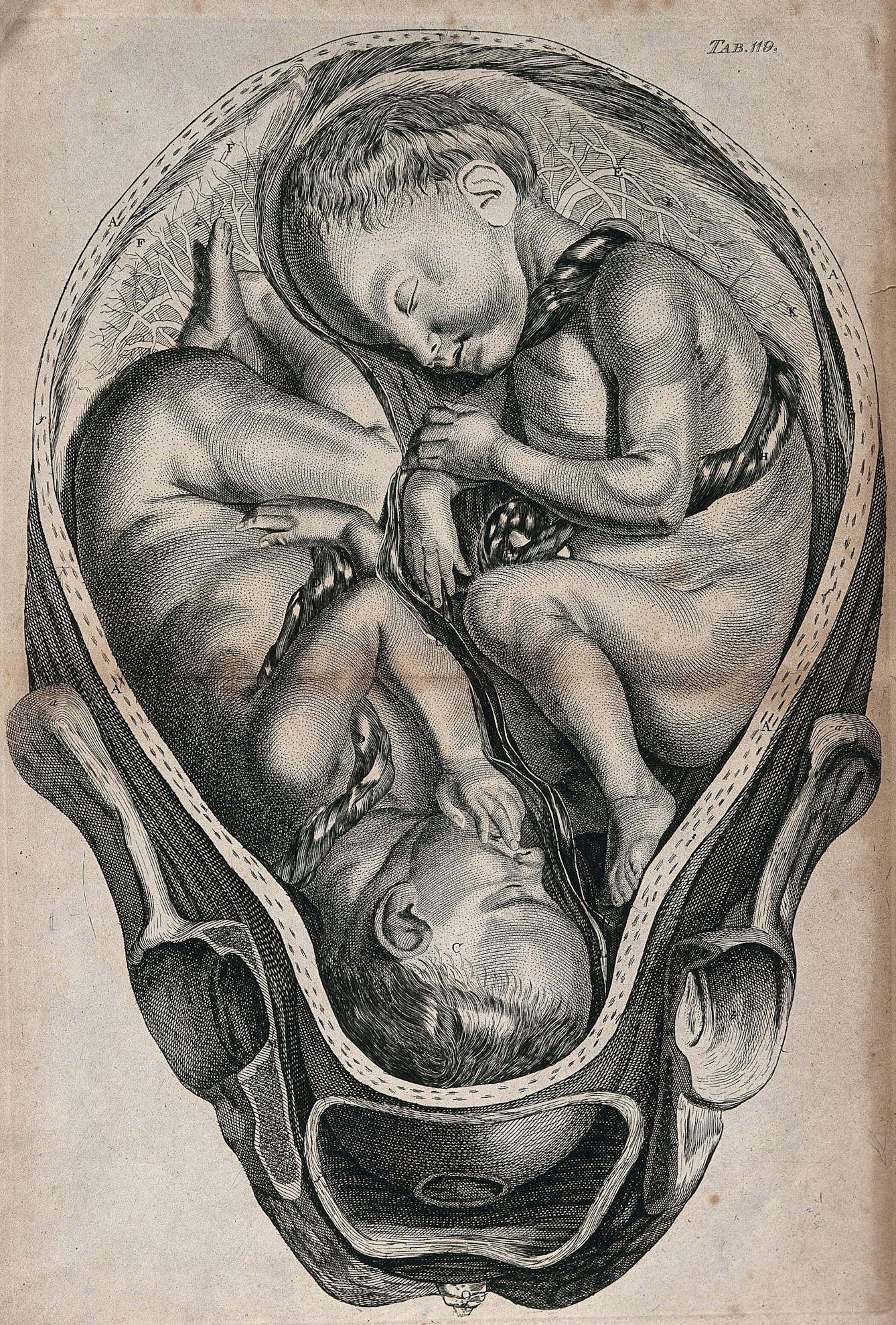 A line engraving print of a cutaway uterus showing two babies lying head-to-toe inside with umbilical cords entwined around the. The babies are almost at full term and have hair and the appearance of being asleep.