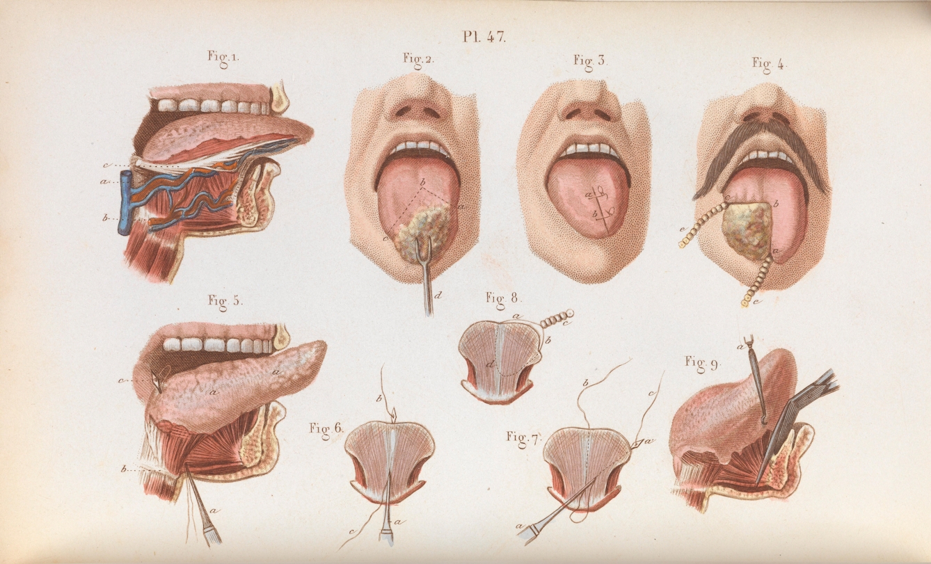 Colourplate of stages of tongue cancer undergoing operative treatment
