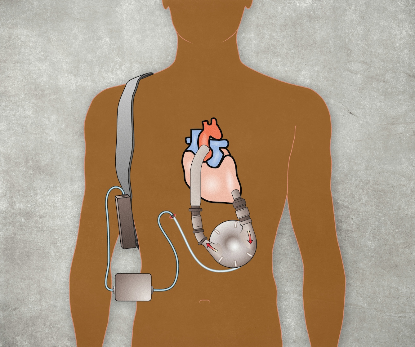 A brown silhouette illustration of a man from the waist up, in front of a cloudy grey background. At the center of the man there is a medical illustration of a heart and a ventricular assist device (LVAD). The device is comprised of a grey circle with one tube connected to the aorta and the other to the base of the heart. There is a wire from the device that connects the internal LVAD to the external control unit through the abdomen. A further wire connects the control unit to a battery pack which is attached to a strap around the man's shoulder.