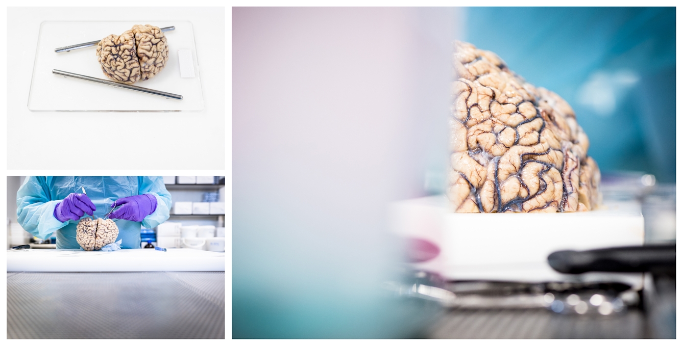 Three photographs clustered together, one large, two small. The large image shows a human brain cut in half resting on a white chopping board. The two smaller images show a Neuropathologist in blue gown and purple gloves dissecting the brain, and the brain on a slicing board.