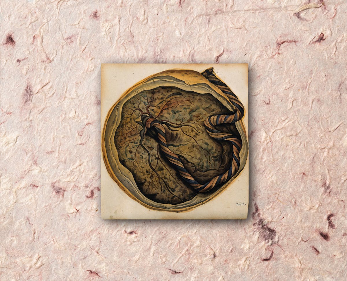 A photograph of a small watercolour painting. The painting depicts an embryonic sac with a twisted rope-like placenta coming from it. The photograph is shown against a pink, textured paper background.