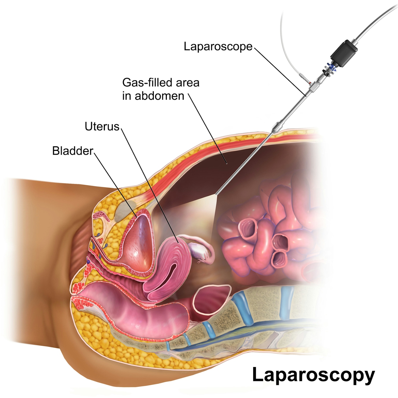 Vector graphic showing a laparoscopy with a laparoscope inserted into the gas-filled space in the abdomen and pointing towards the uterus and bladder.