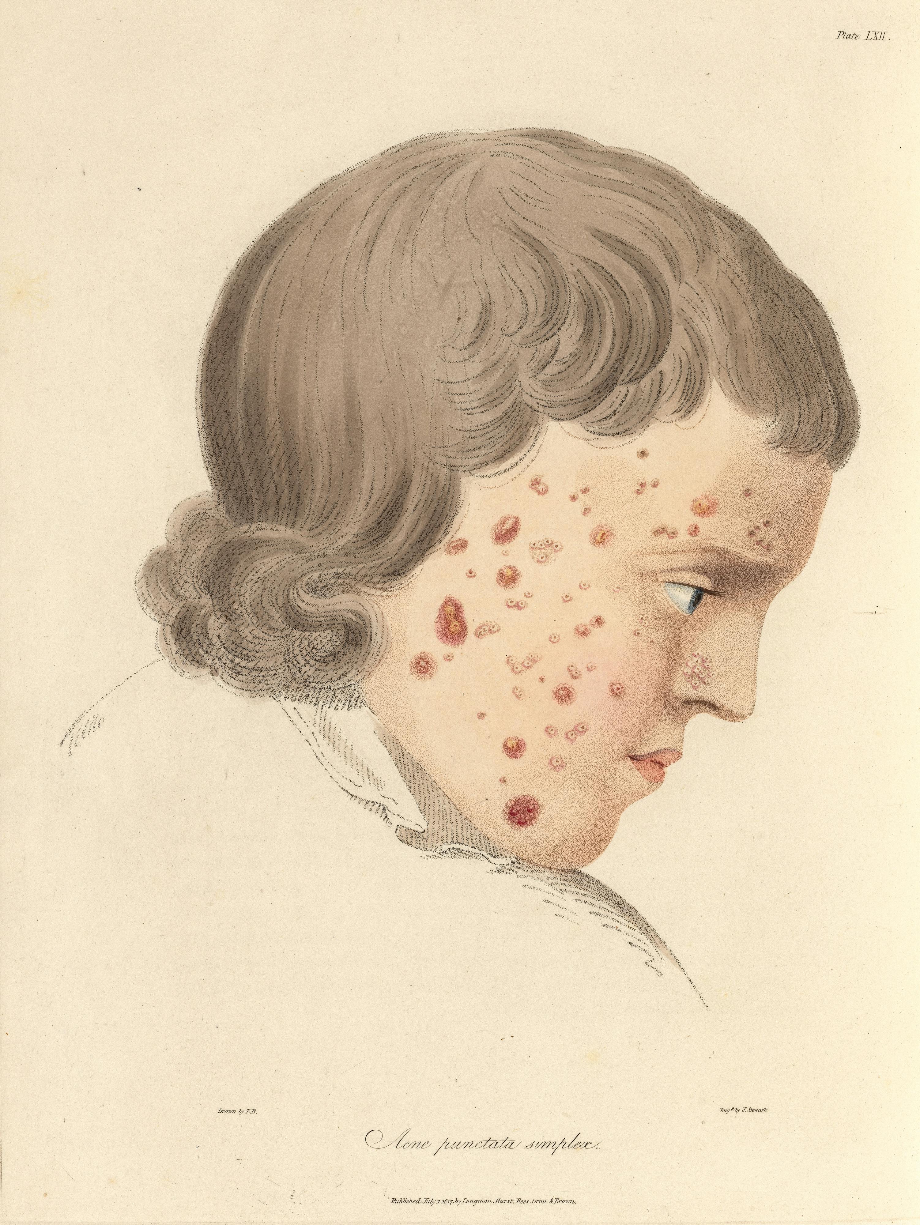 Face to face with acne | Wellcome Collection