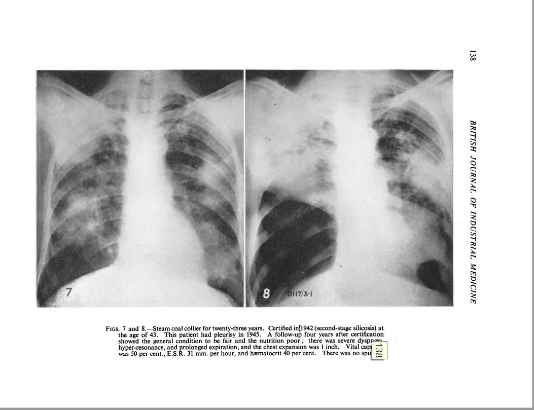 Black and white image of two lung x-rays, of a steam coal collier for 23 years. 