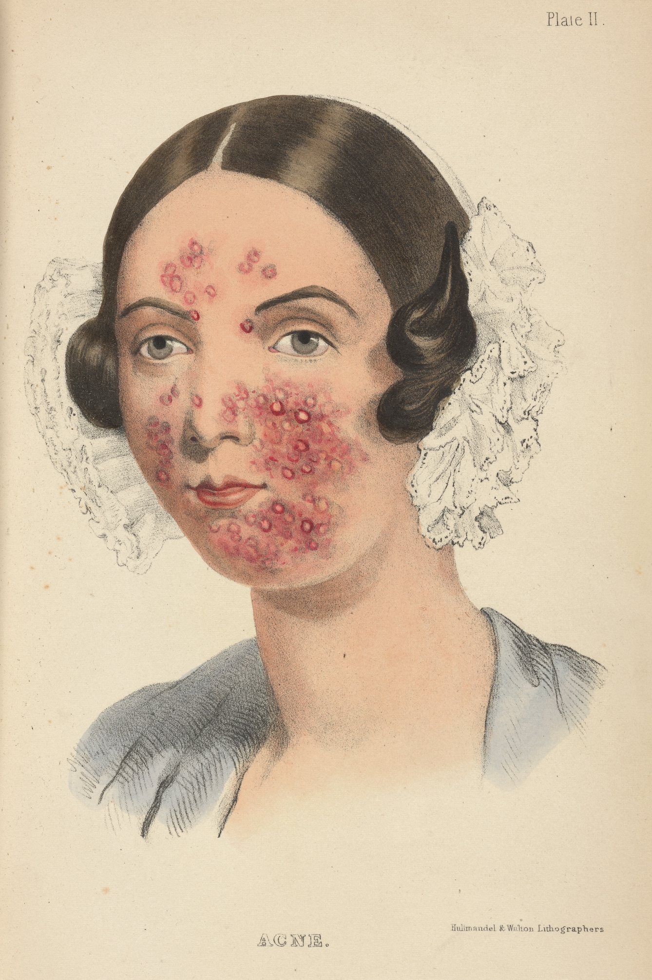 Photograph of an illustration showing the head and shoulders of a woman in a bonnet with red acne marks on her face.