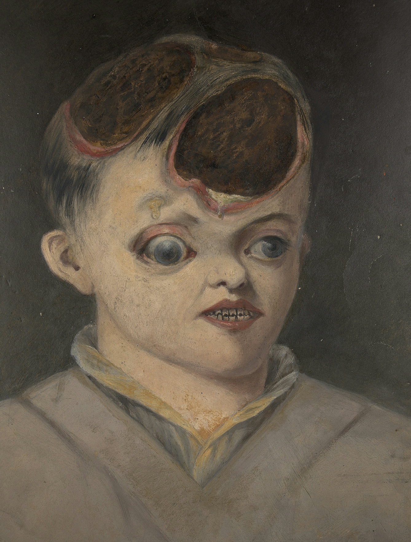 A 16-year-old girl with congenital syphilis.