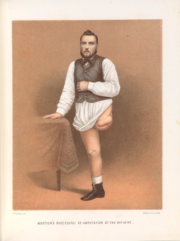 Colour book illustration showing a young man with one leg amputated at the hip