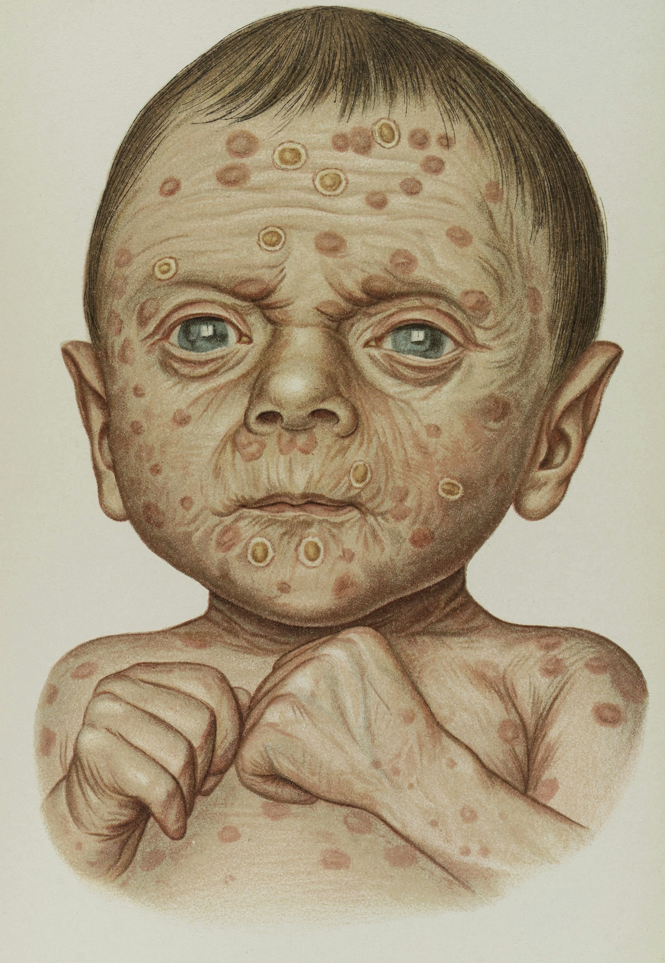 A four-week-old baby with congenital syphilis.