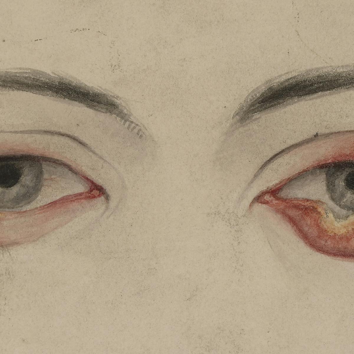 Tertiary syphilitic affection of the lower eyelids