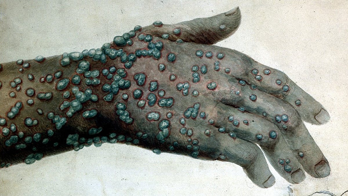 A hand and wrist with green smallpox pustules, 1831