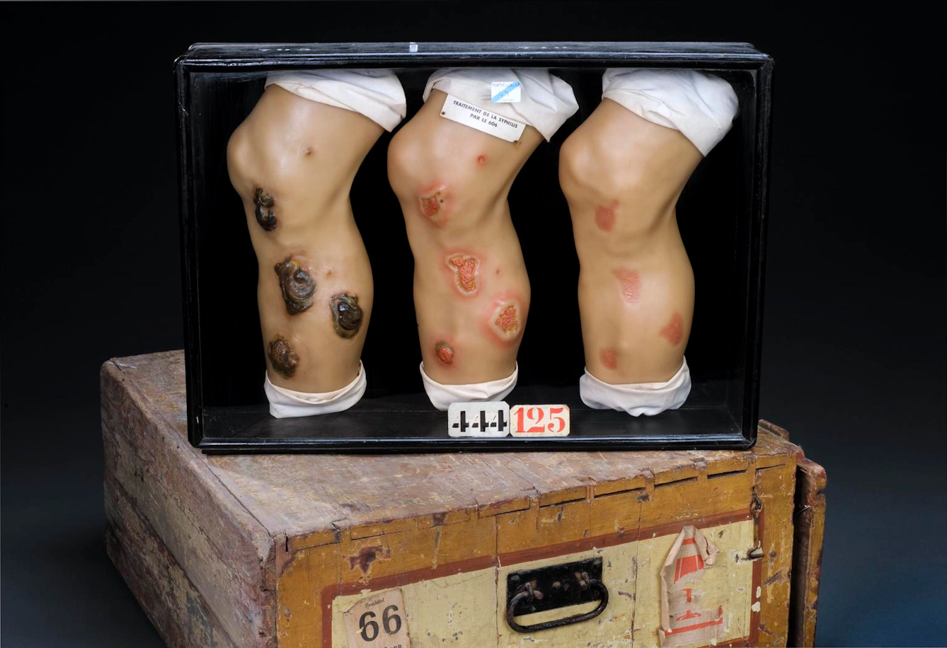 Glass display case containing three wax leg models showing stages of healing from syphilis ulcers after treatment with Salvarsan, displayed on a wooden crate.