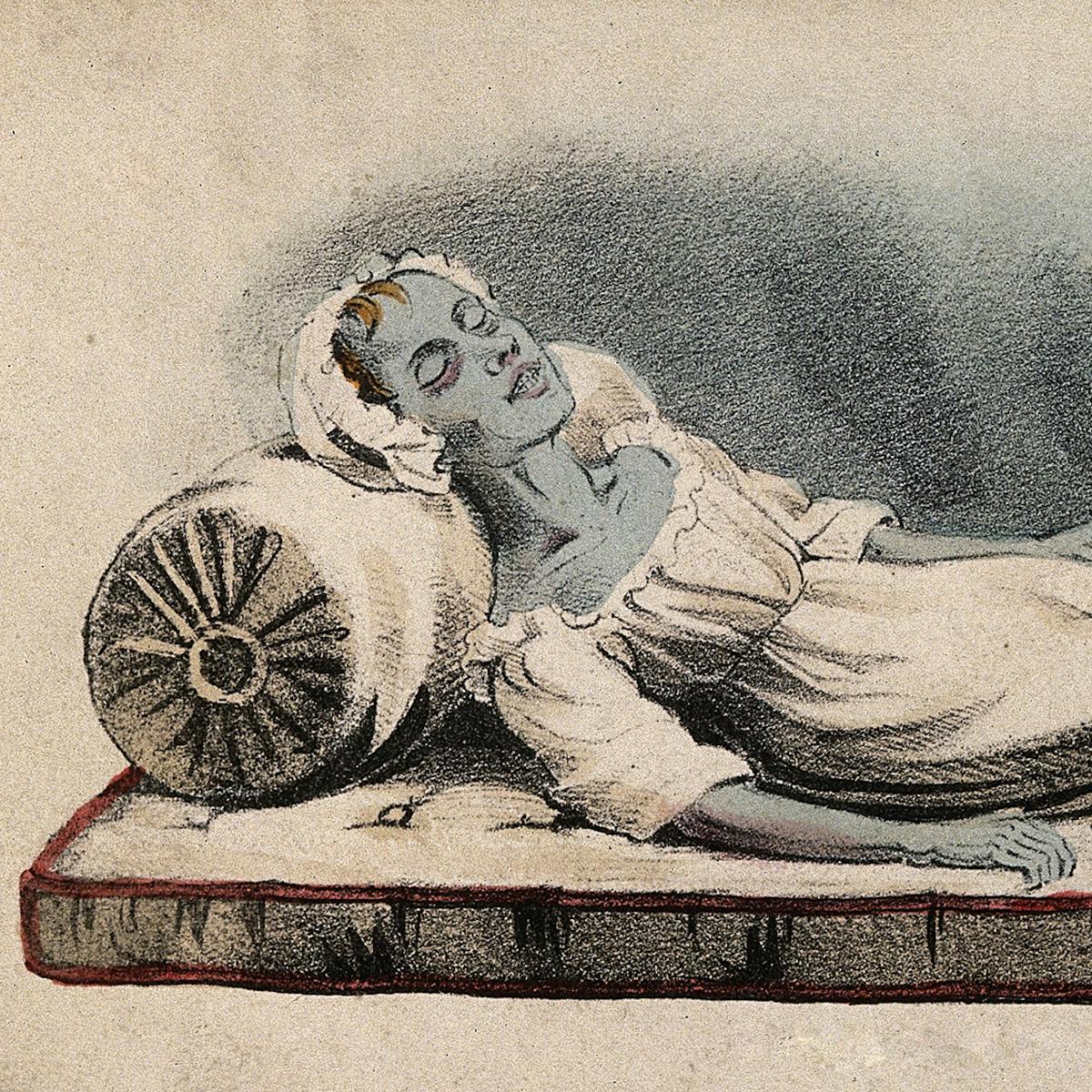 A dead victim of cholera in Sunderland, 1832