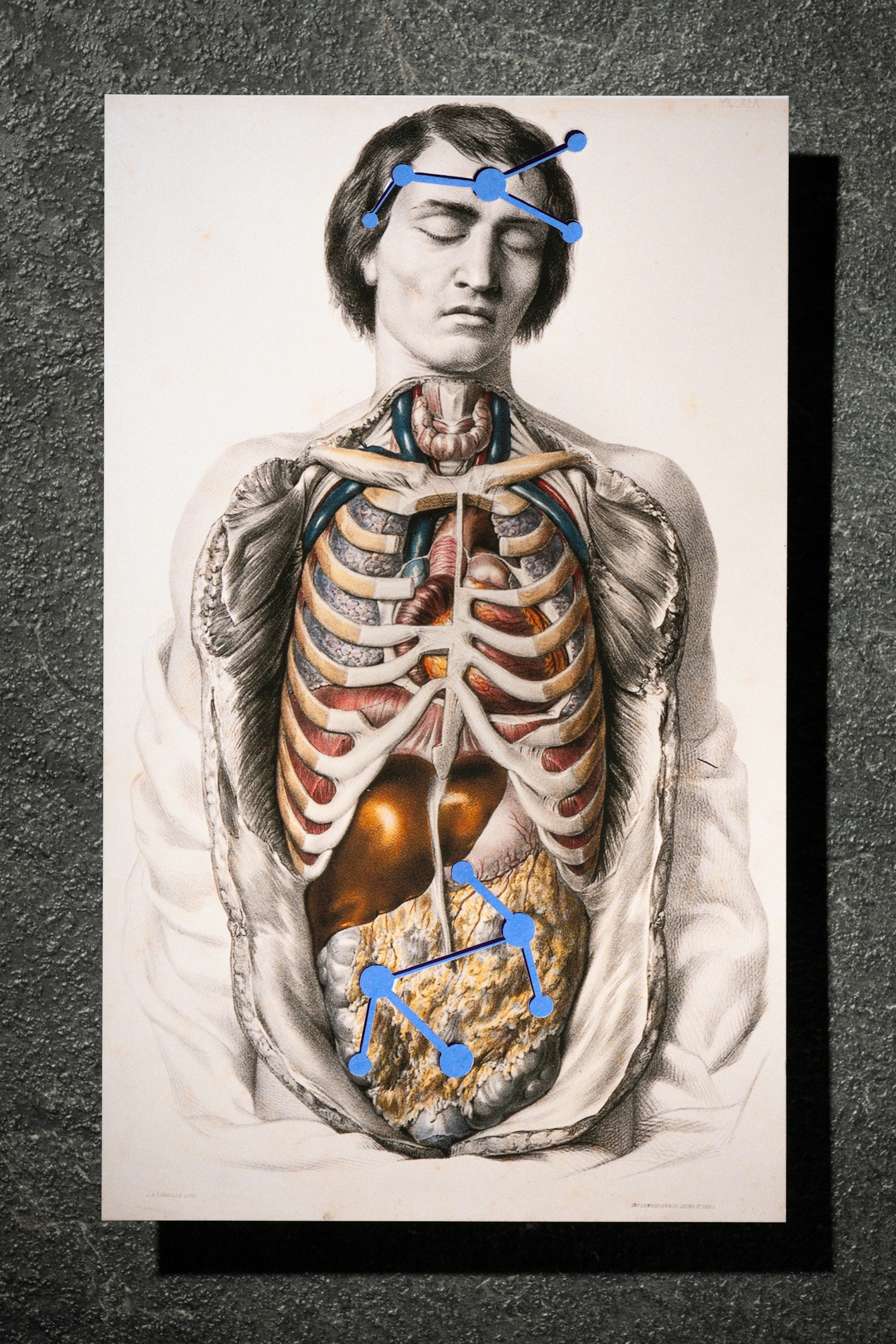 A photograph of a picture displaying a dissected man. Inter-connected blue circles are shown over the mans stomach and head.