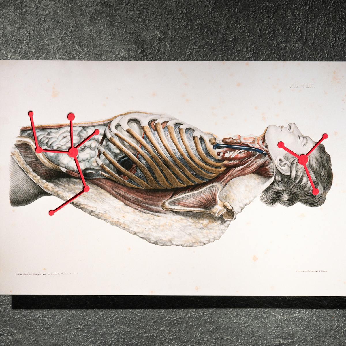 A photograph of a picture displaying a dissected man. Inter-connected red circles are shown over the mans stomach and head.
