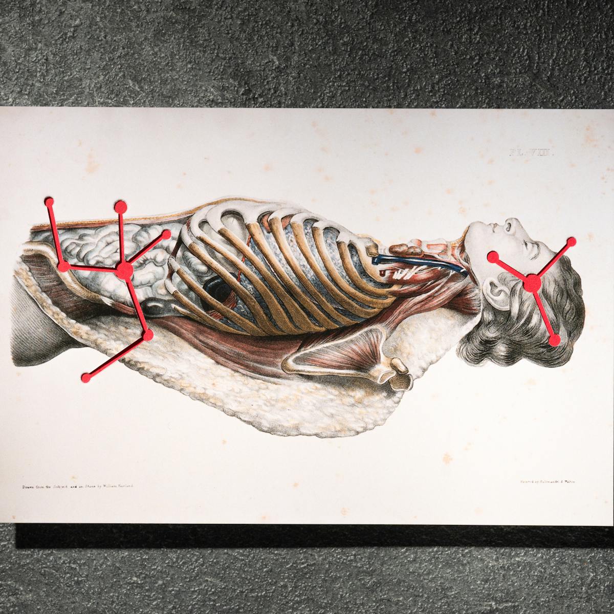 A photograph of a picture displaying a dissected man. Inter-connected red circles are shown over the mans stomach and head.