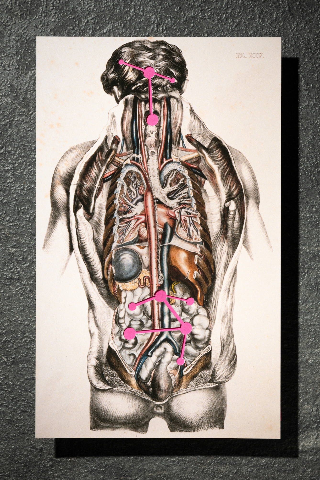 A photograph of a picture displaying a dissected man. Inter-connected pink circles are shown over the mans stomach and head.