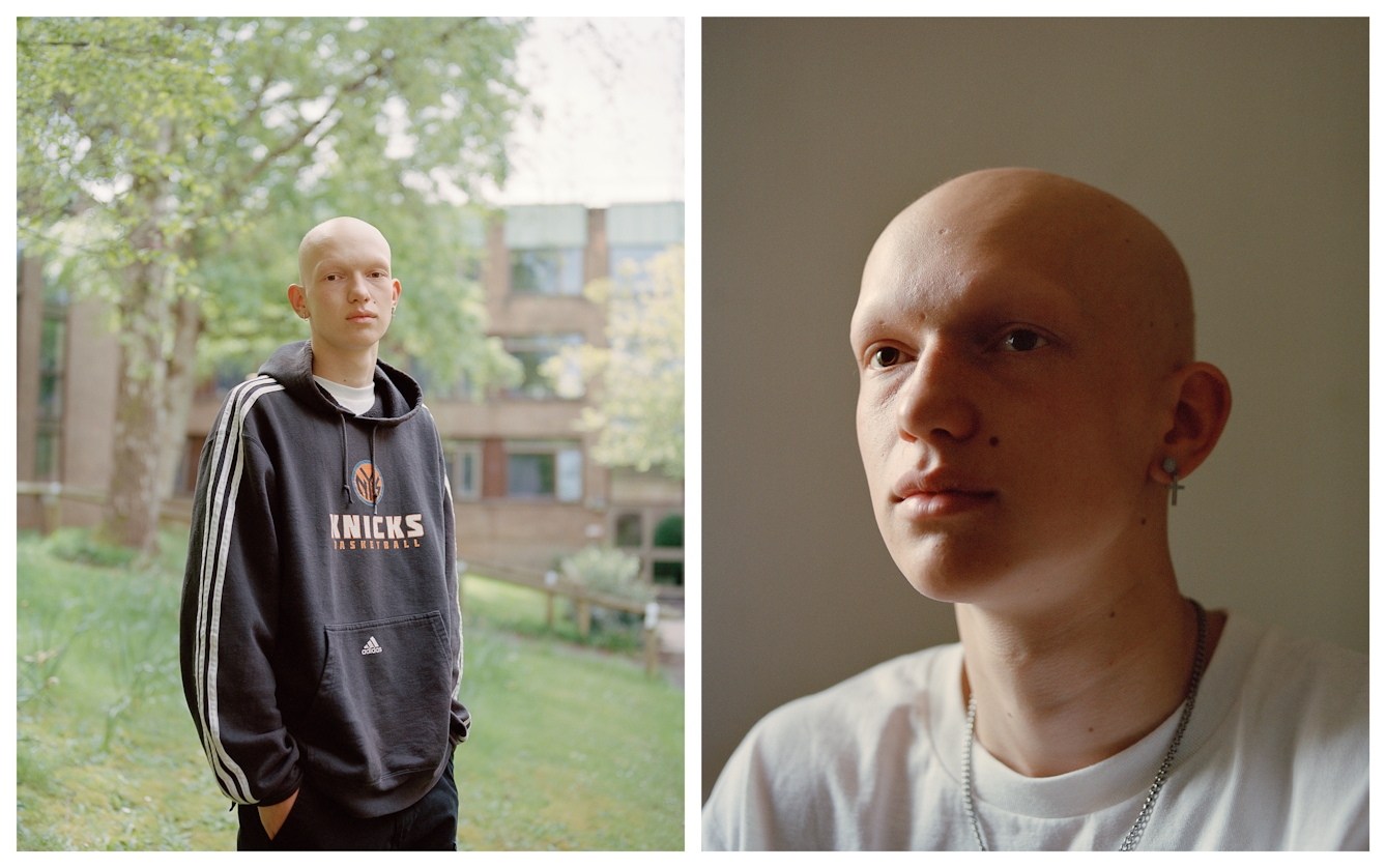 Photographic portrait of a man with alopecia universalis presented as a diptych. The image on the left shows the man from the waist up looking straight to camera. He is stood in a landscaped scene outside a red brick building. The image on the right is a closeup of the man's head as he gazes off to the left.