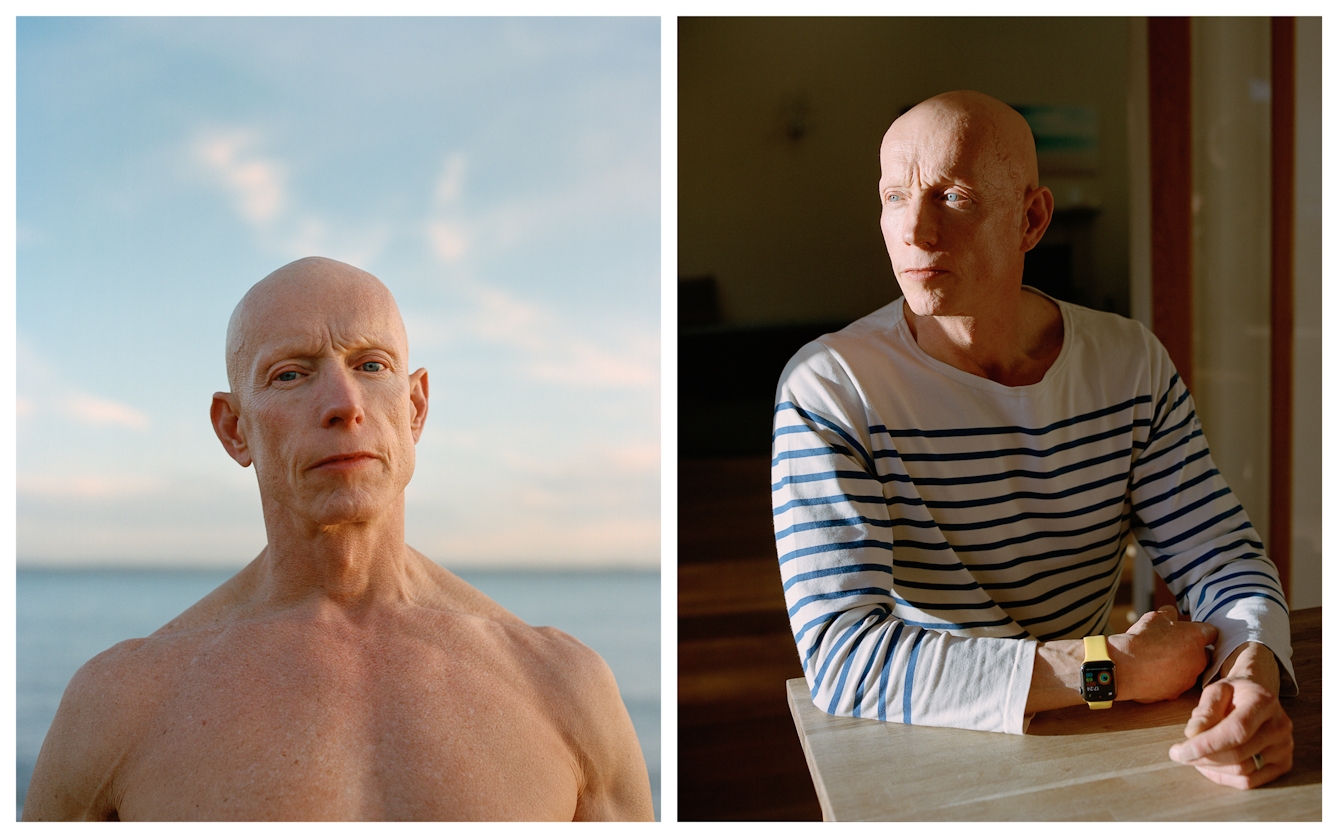 Photographic portrait of a man with alopecia universalis presented as a diptych. The image on the left shows the man from the chest up on a beach, looking straight to camera. The image on the right show the man seated at a table looking off to the left, bathed in sunlight.