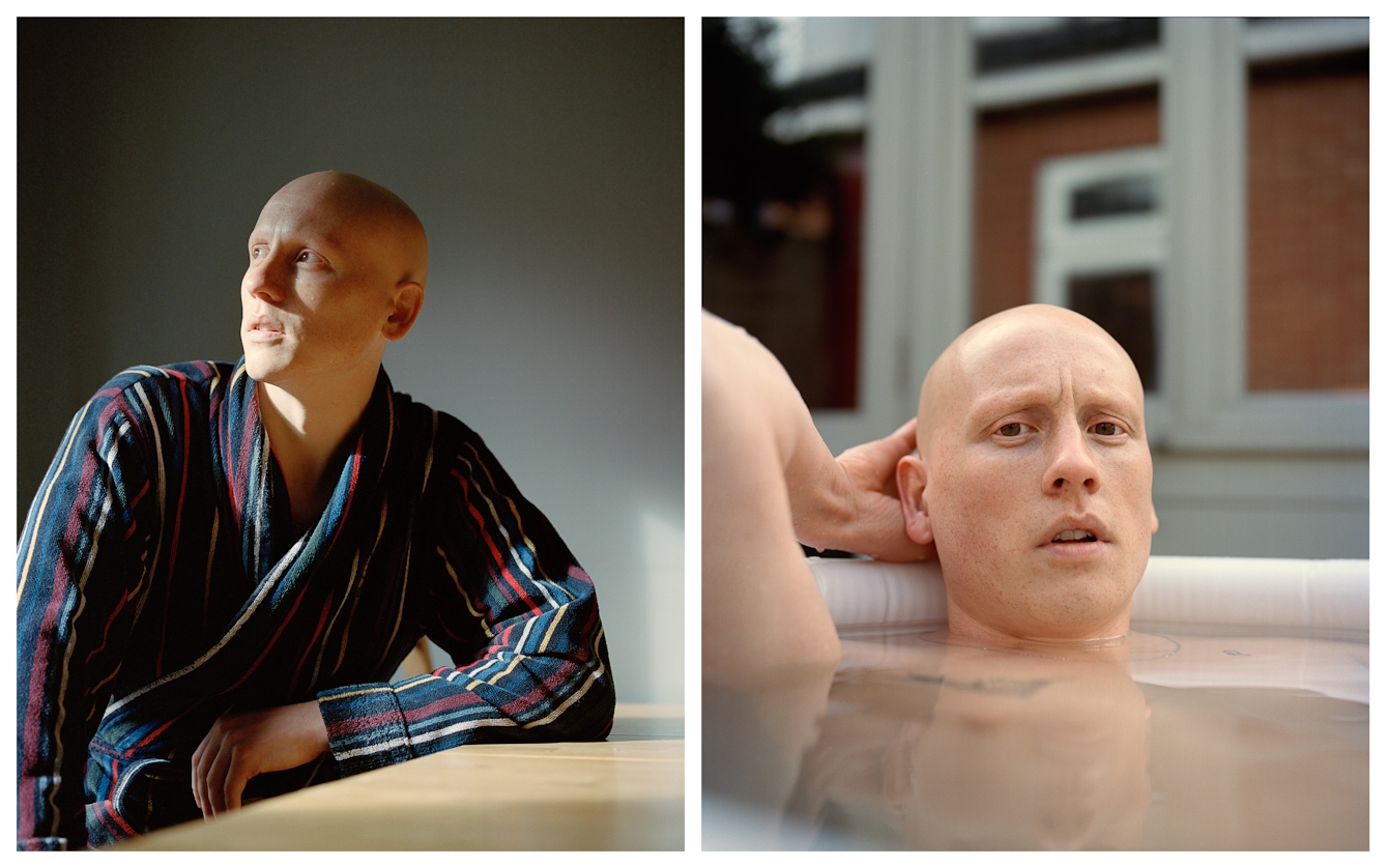 Photographic portrait of a man with alopecia universalis presented as a diptych. The image on the left shows the man in a towelling dressing gown, arm resting on a table, gazing off into the distance to the left. The image on the right shows the man submerged in a garden hot tub up to his neck, looking straight to camera.